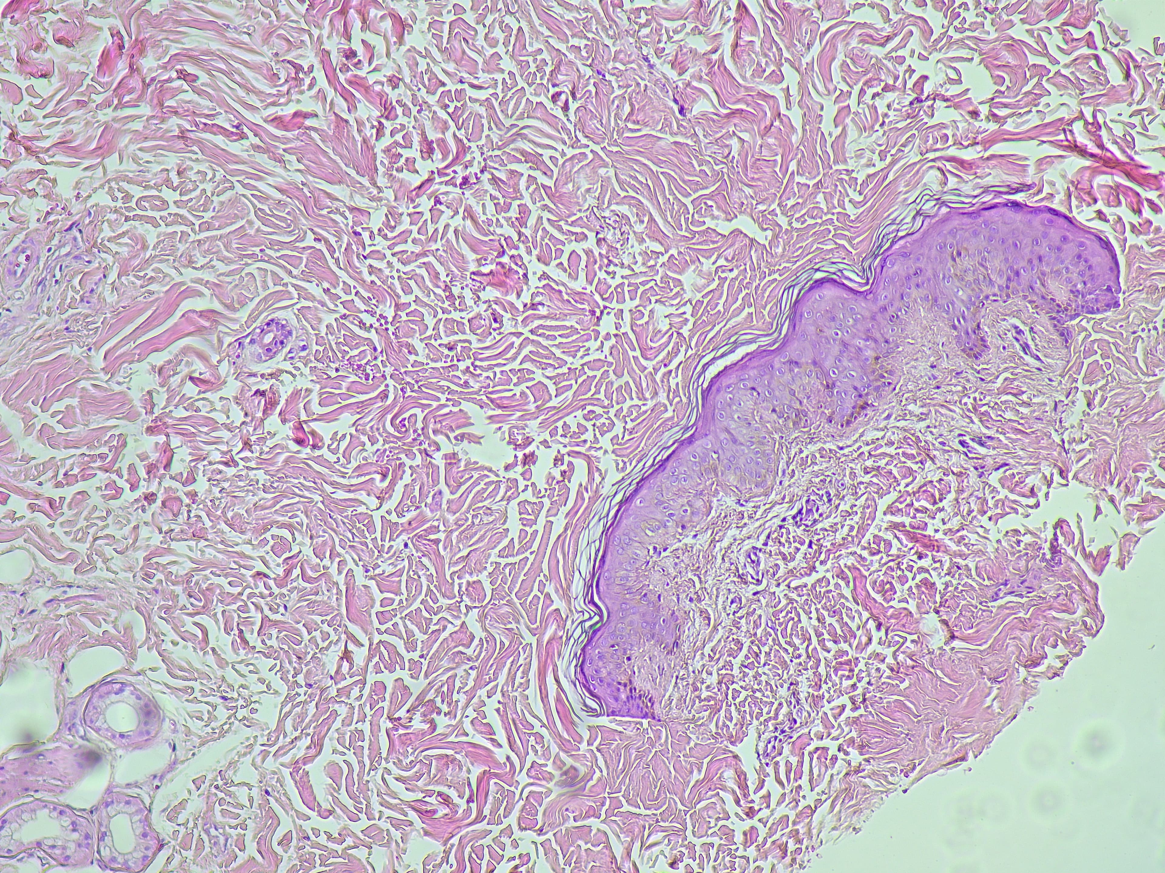 Basalzellkarzinom (BCC) Basalzellkarzinom